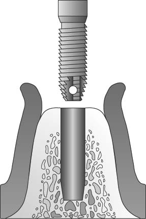 Implant Insertion