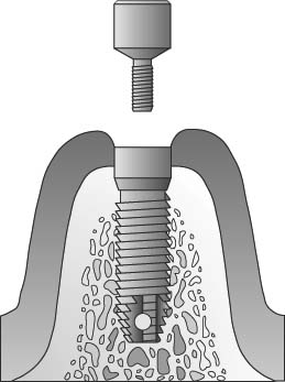 Implant Exposure