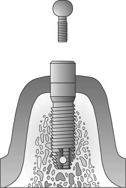 Attachment Insertion