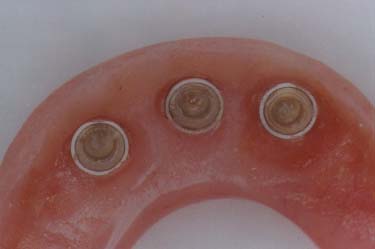 Underside Overdenture